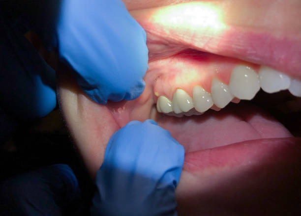 Best Emergency Tooth Extraction  in Kraemer, LA